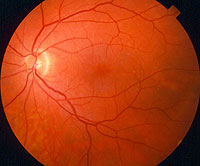Retinal Tear Treatment | Macular Degeneration | Diabetic Retinopathy | Beverly Hills CA